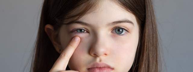 How to Treat Red Swollen Eyes