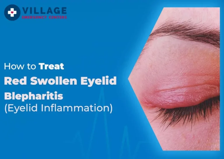 blog image for the topic: How to Treat Red Swollen Eyelid - Blepharitis (Eyelid Inflammation)