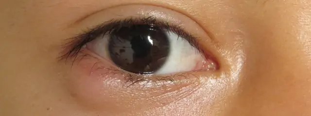 Bump Forming Under Eye – Identifying Types & Treatments