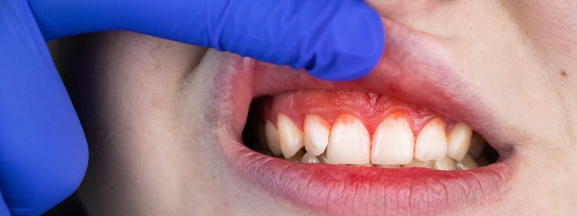 What Causes Bleeding from the Mouth
