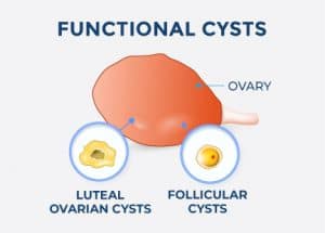 functional cysts