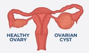 ovarian cyst diagram