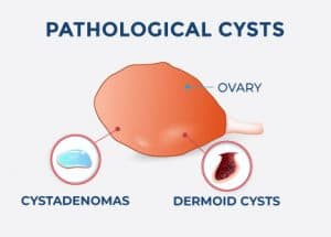 pathological cysts