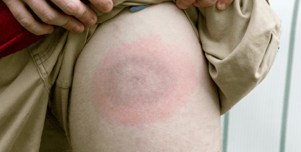 inflamed rash is a common symptom of lyme diesease
