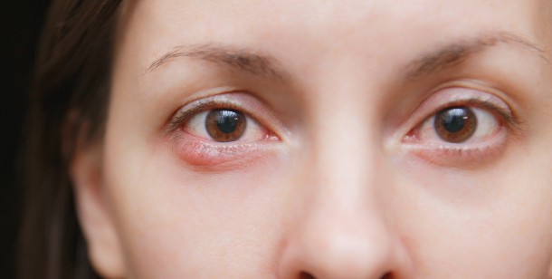 what is blepharitis