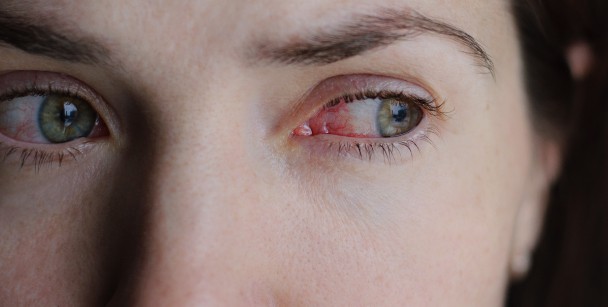 Red Bumps Under The Eyes: Causes and Effective Treatments