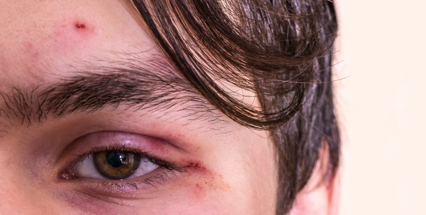 types of eyelid injuries