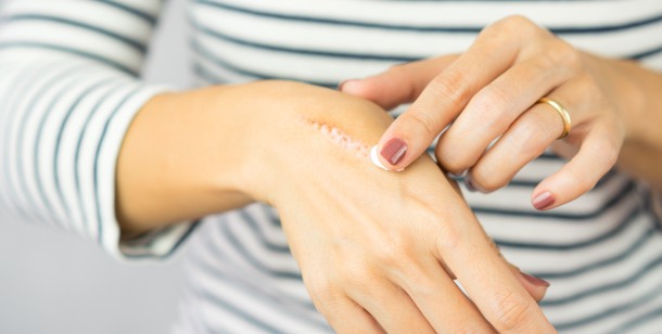 Hot Pan Burned My Hand — Treatment Tips - Mayo Clinic News Network