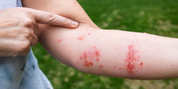 medical help for poisonous plant rash