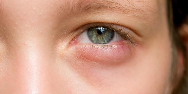 what is a swollen eye