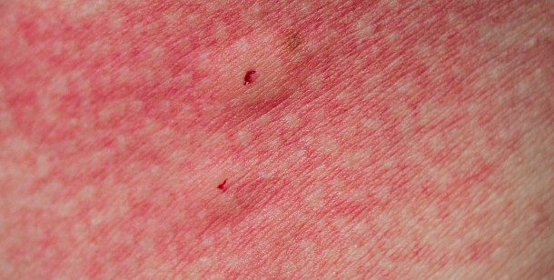 Spider Bite Pictures - What They Look Like, How To Treat Symptoms