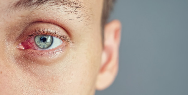 What Is Commonly Misdiagnosed as Pink Eye