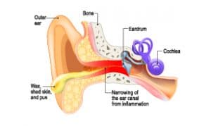 Graphic showing the outer ear, bone, eardrum, cochlea, ear wax, and narrowing of the canal from inflammation