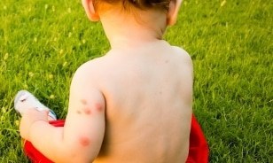 when to seek medical attention for a bug bite