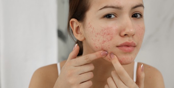 side effects of using accutane