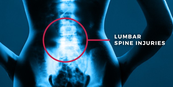 Lumbar Spine Injuries