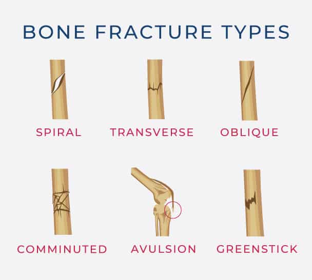 broken bones types