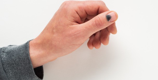Hand and wrist injuries: Nail Bed Injury