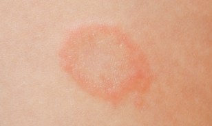 Discover More Than 145 Itchy Ring On Skin Latest Xkldase Edu Vn   Village Emergency Room Blog Ringworm ER Tinea Skin Rash 1 