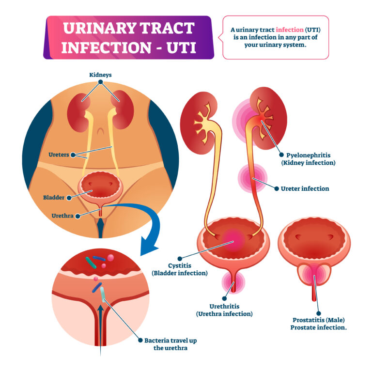 What are the Signs and Symptoms of a Urinary Tract Infection?