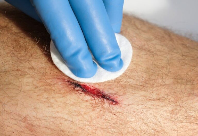 A Network of Emergency Rooms Explains: How to Tell If a Wound is Healing or Infected