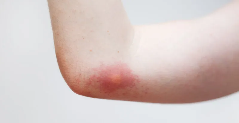 Allergic Reactions to Bug Bites & Stings