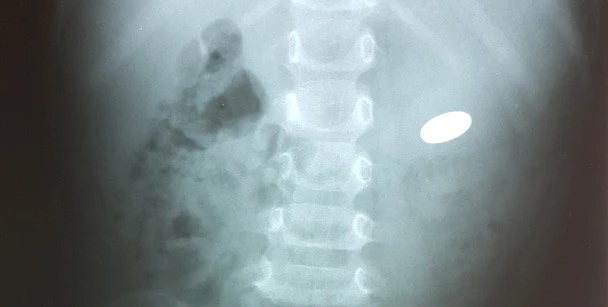 Medical x-ray in Jersey Village showing detailed bone structure for emergency diagnosis